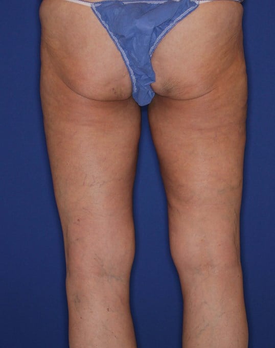 Outer & Inner Thighs After