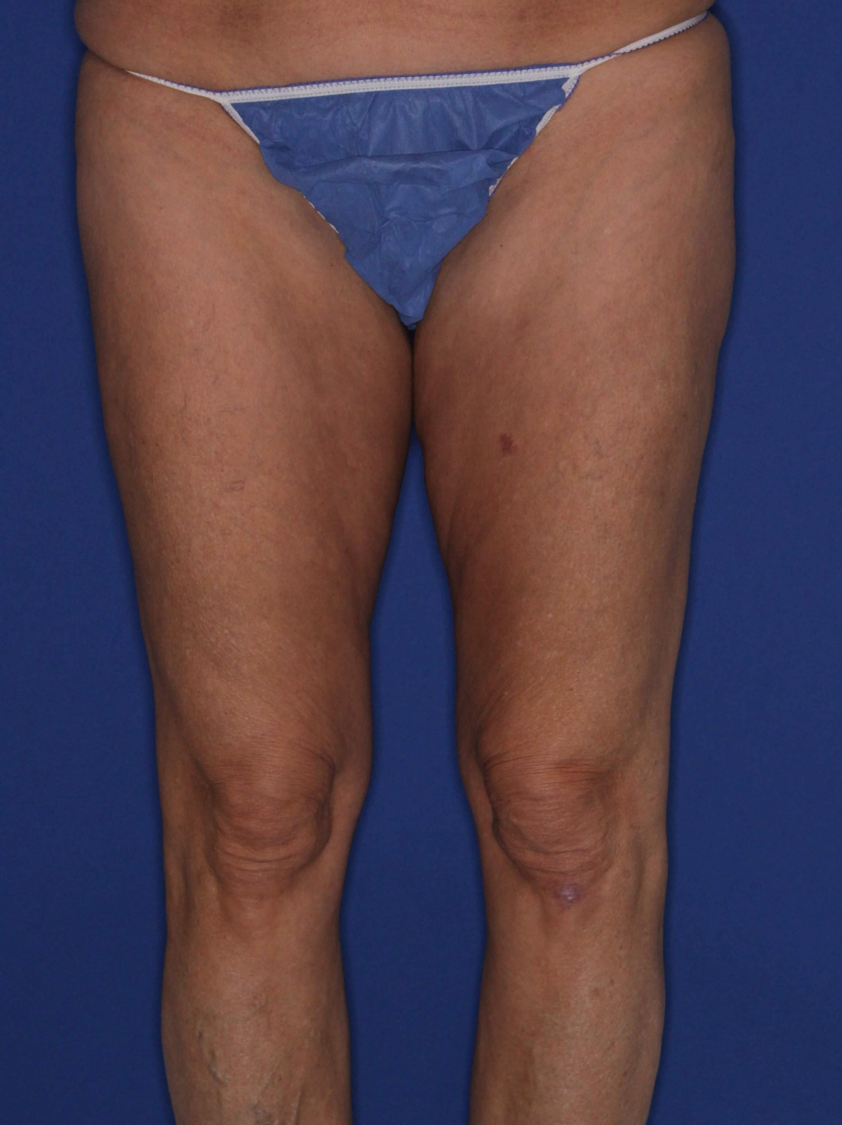 Outer & Inner Thighs Before