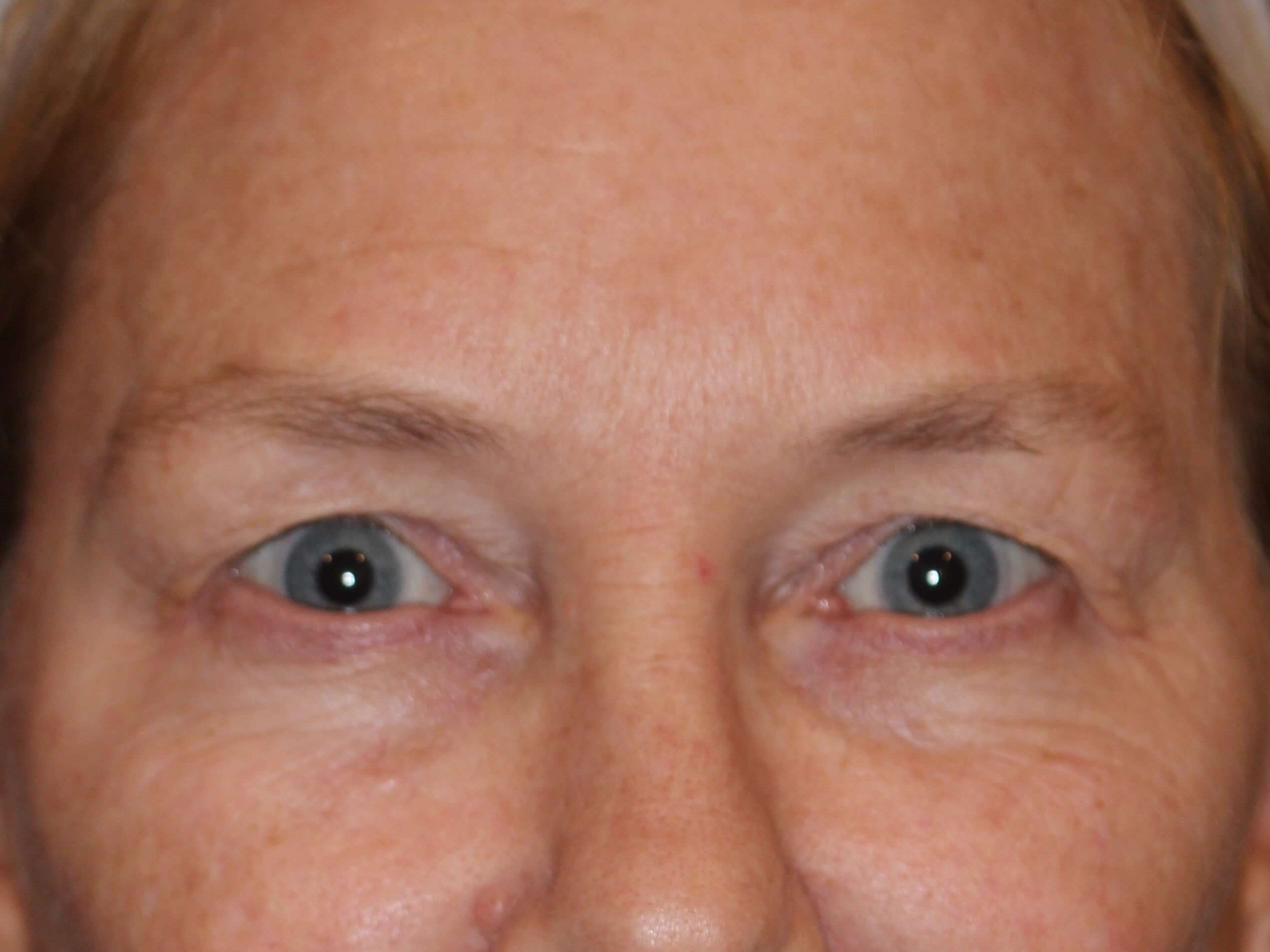 Upper Eyelid Lift Before
