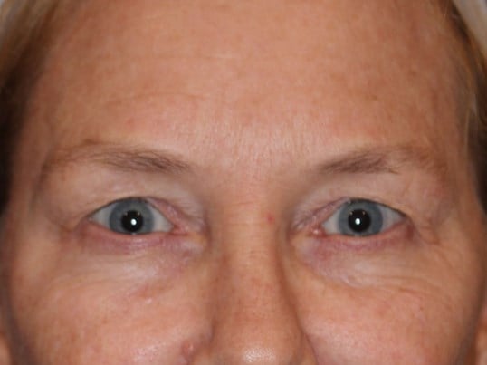 Upper Eyelid Lift Before