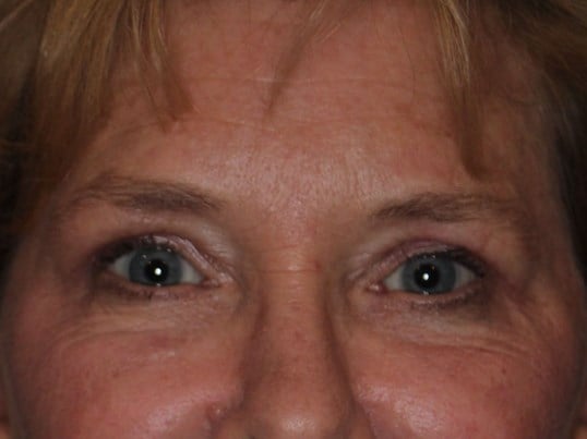 Upper Eyelid Lift After