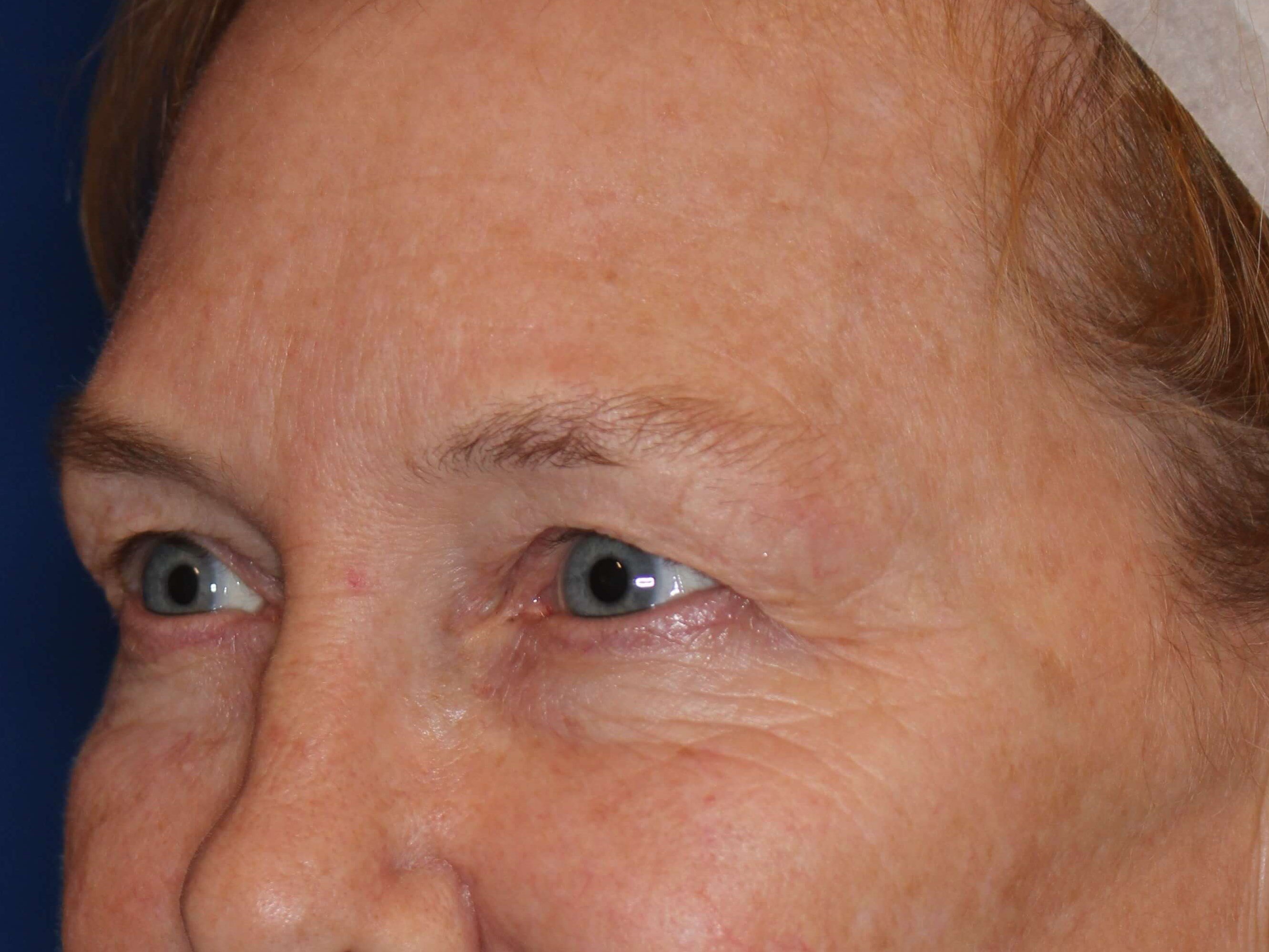 Upper Eyelid Lift Before