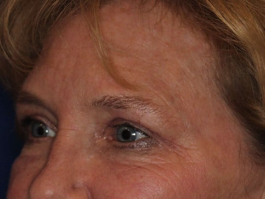 Upper Eyelid Lift After