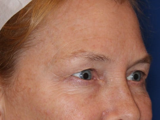 Upper Eyelid Lift Before