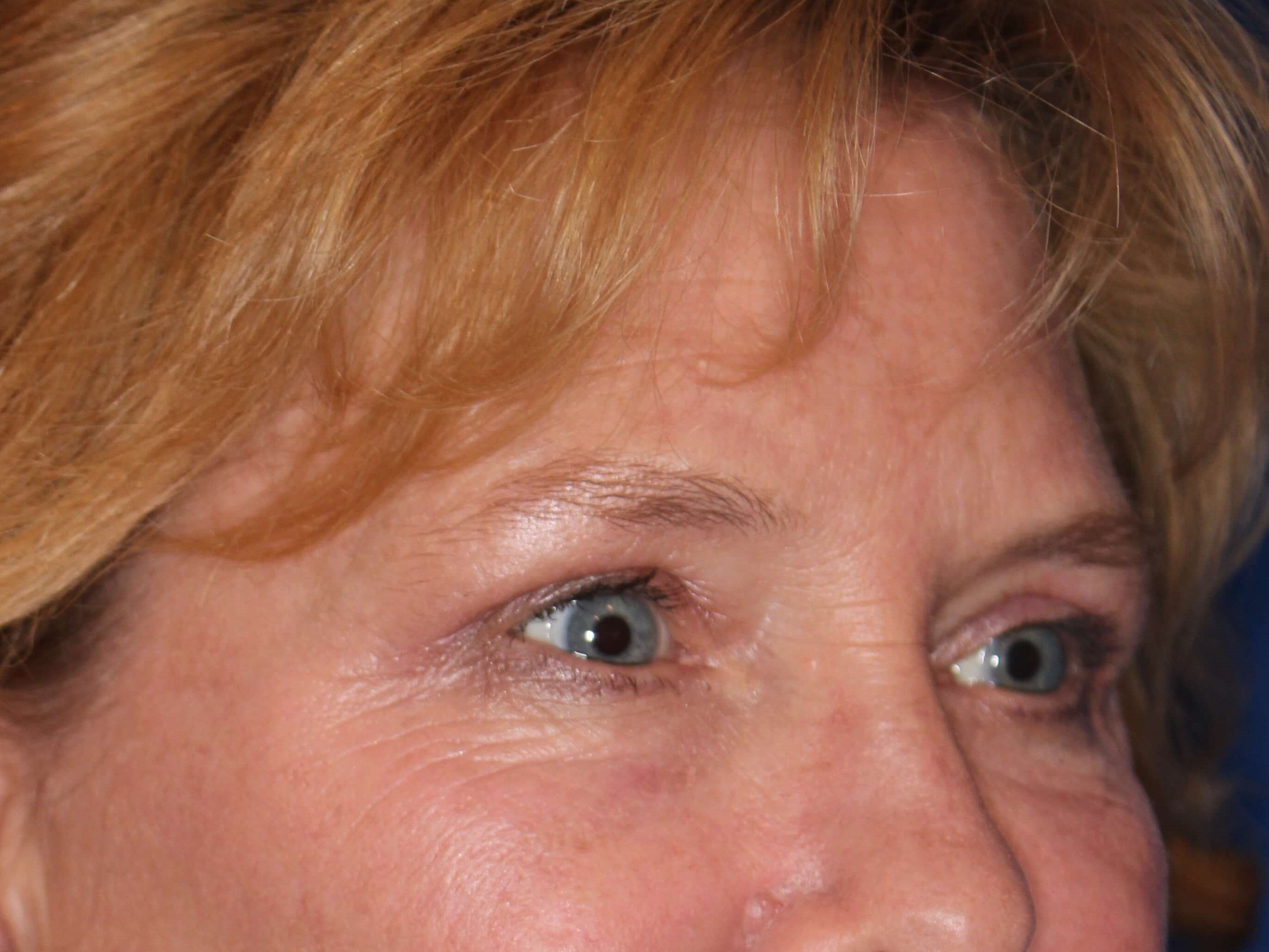 Upper Eyelid Lift After