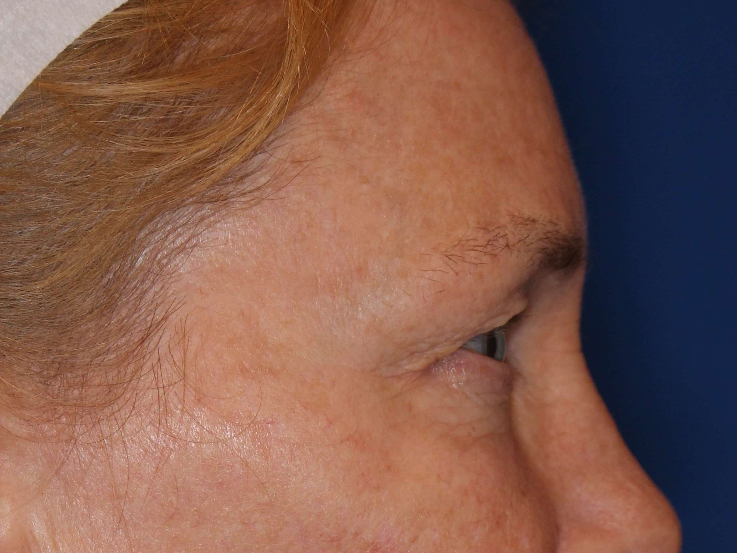 Upper Eyelid Lift Before