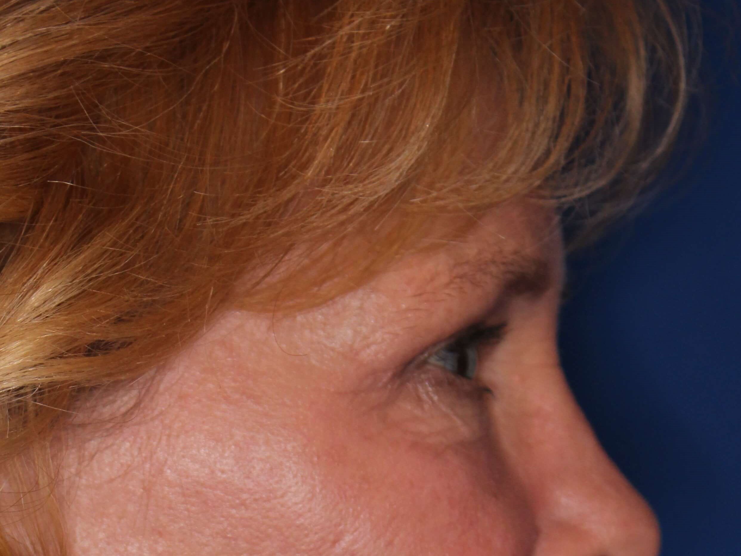 Upper Eyelid Lift After