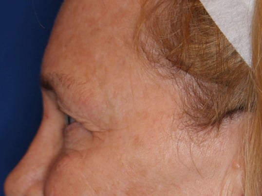 Upper Eyelid Lift Before
