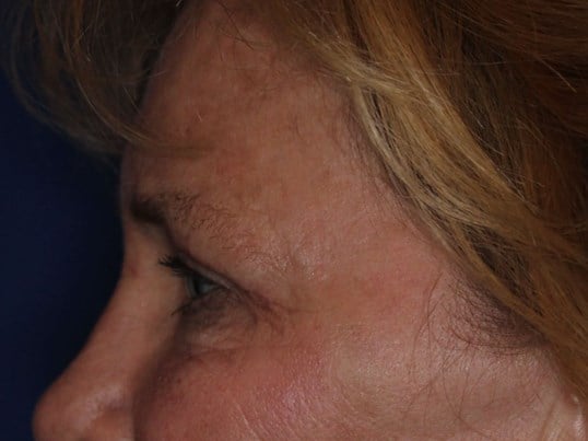 Upper Eyelid Lift After