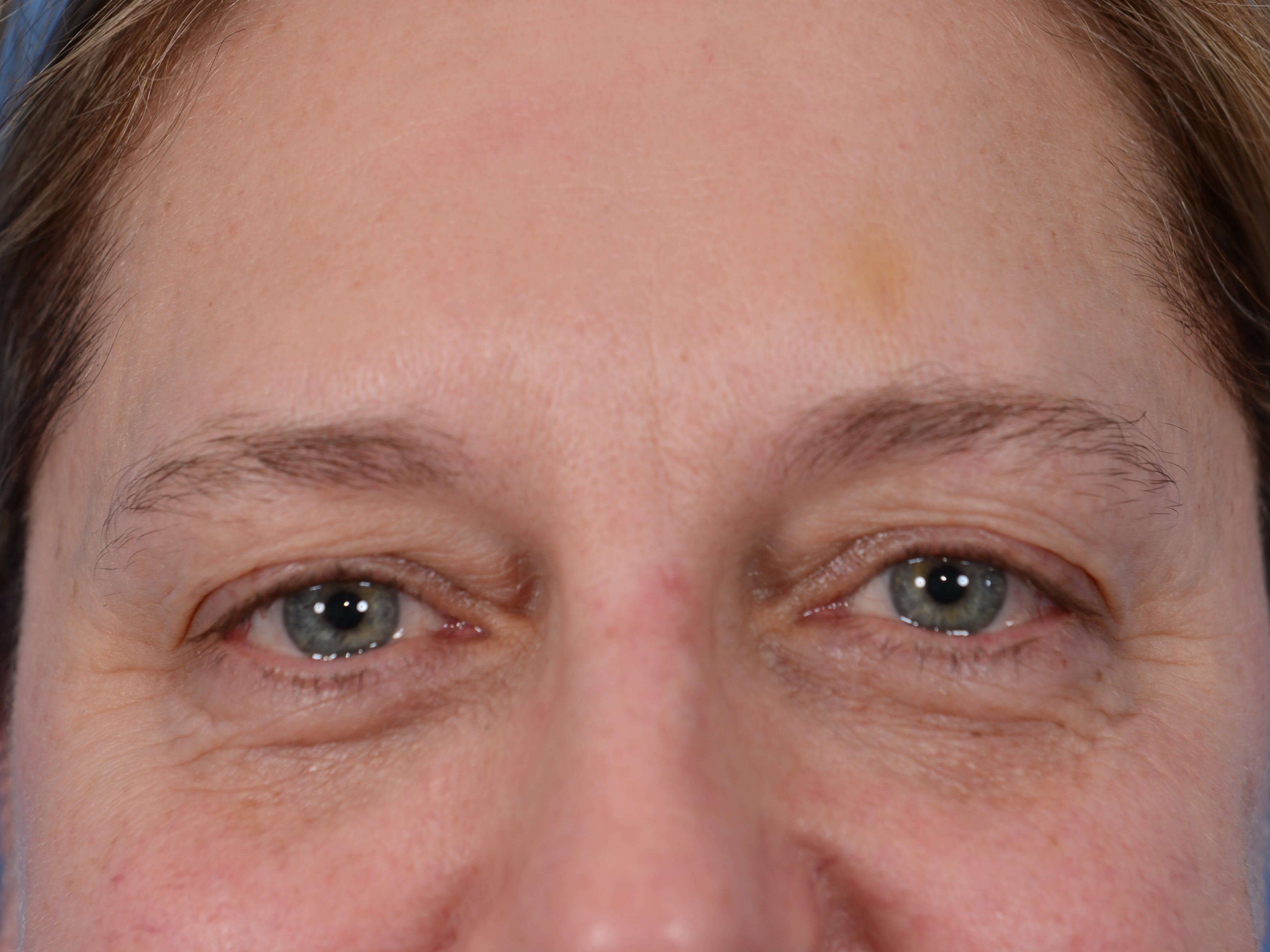 Upper Eyelid Lift Before