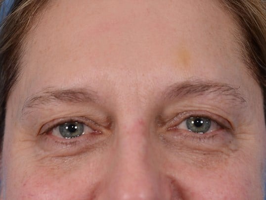 Upper Eyelid Lift Before