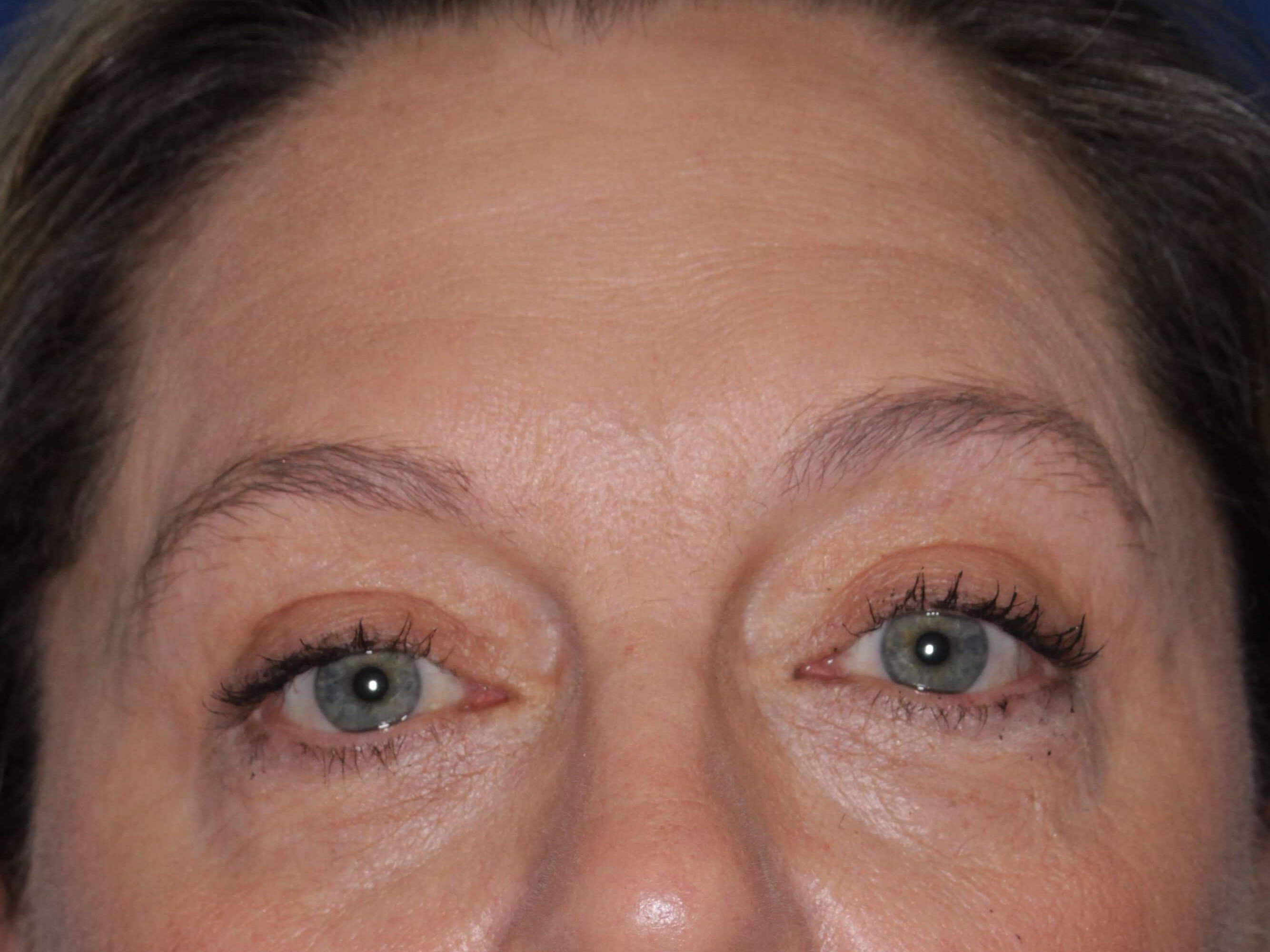 Upper Eyelid Lift After