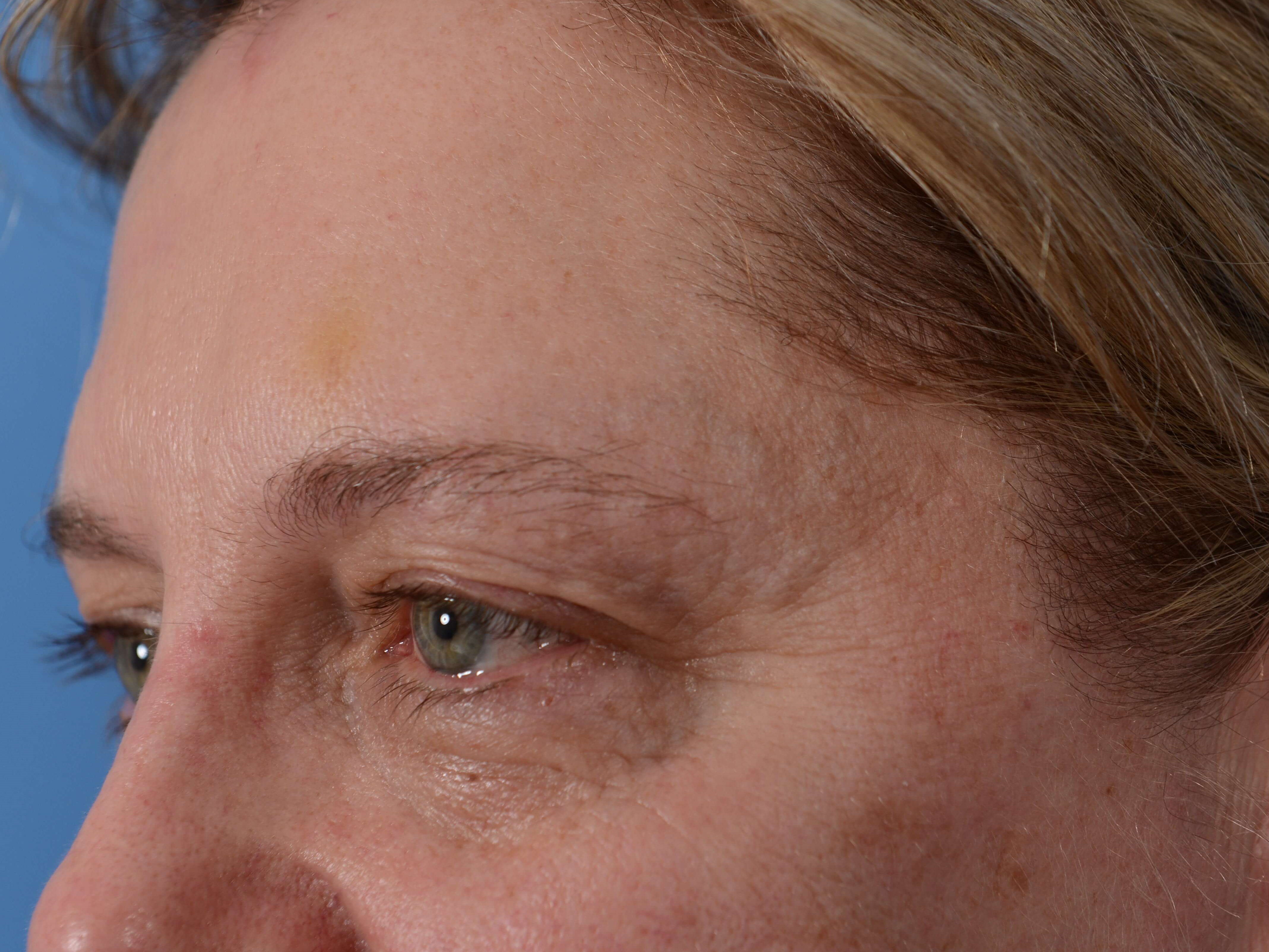 Upper Eyelid Lift Before