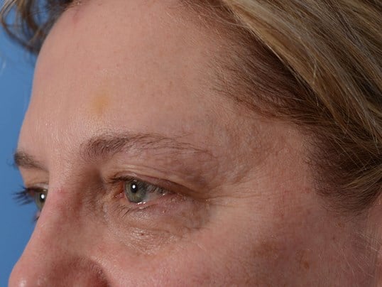 Upper Eyelid Lift Before