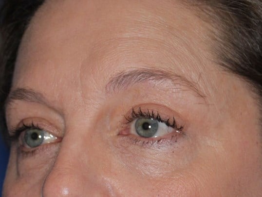 Upper Eyelid Lift After