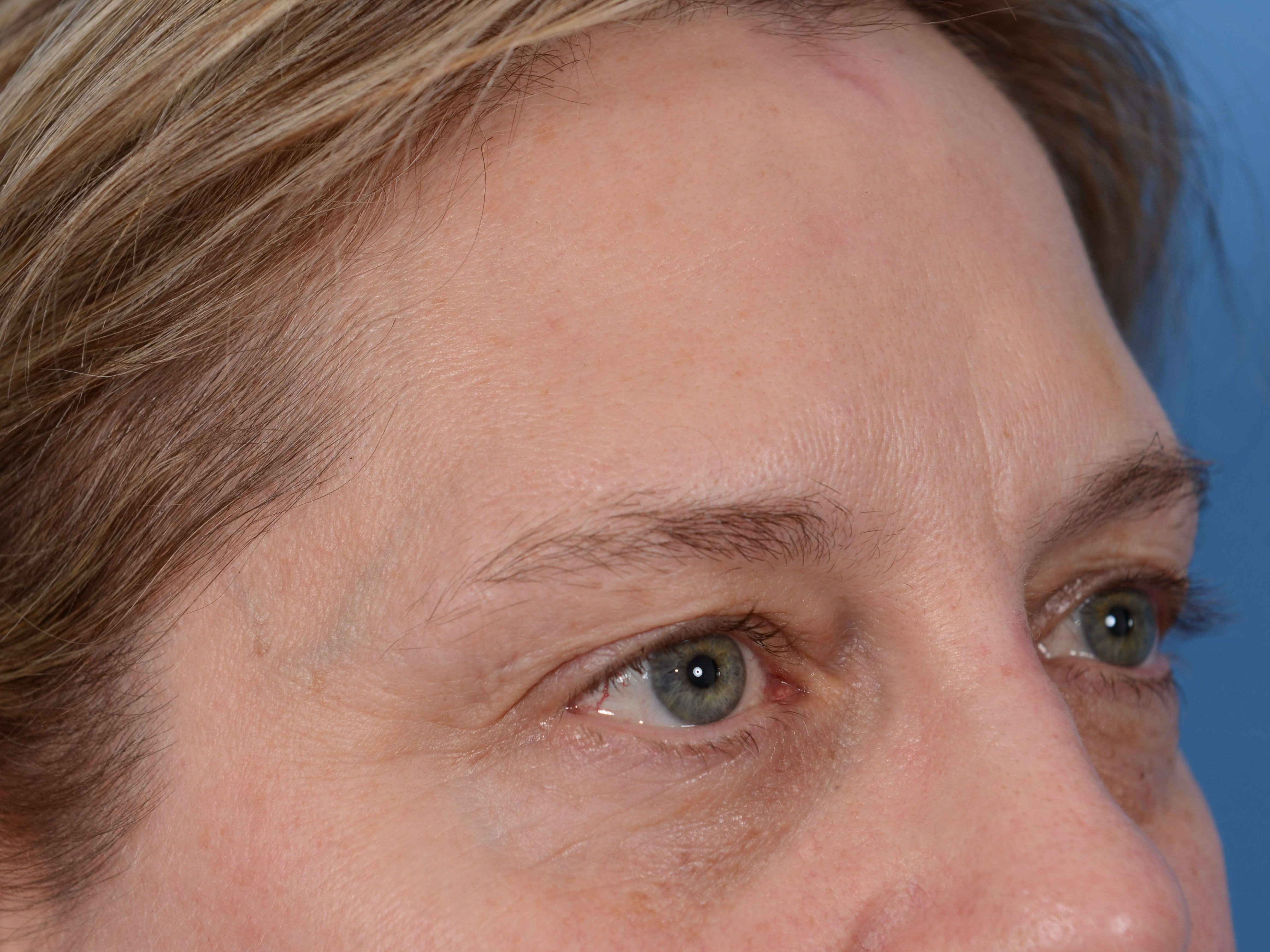 Upper Eyelid Lift Before