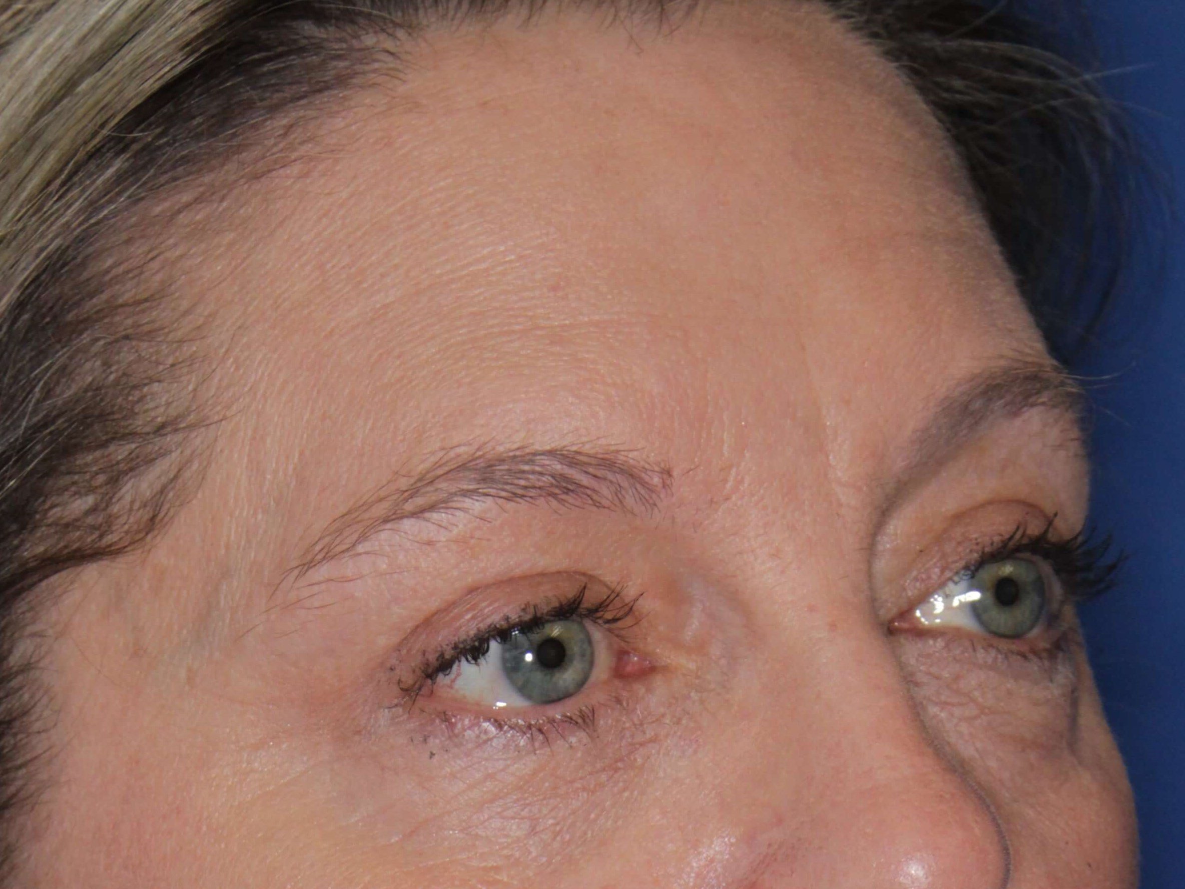 Upper Eyelid Lift After