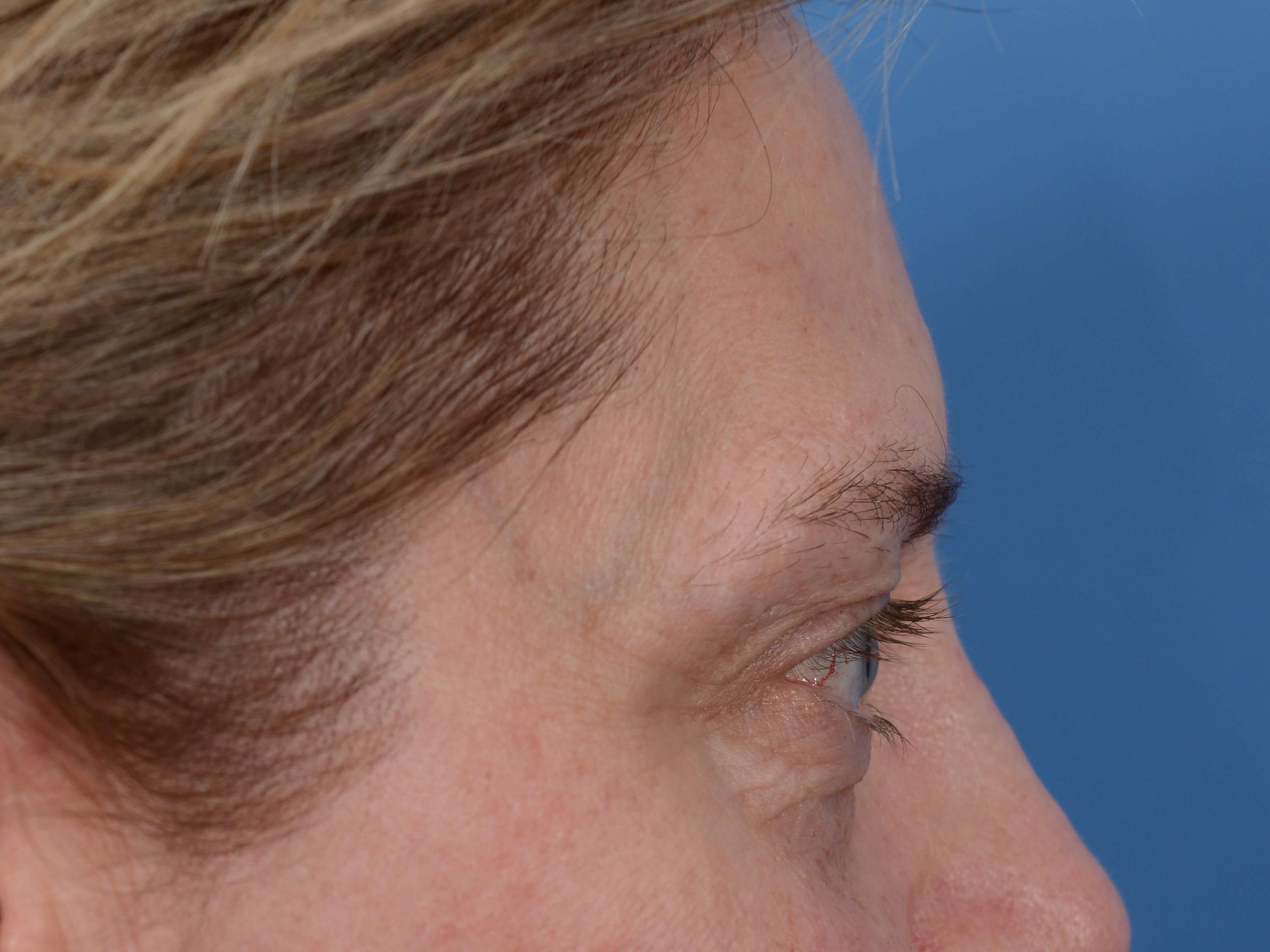 Upper Eyelid Lift Before