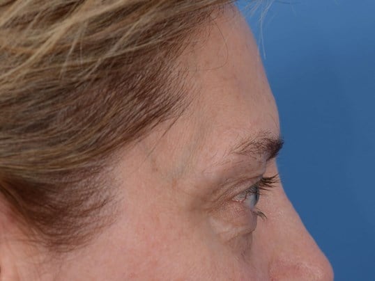 Upper Eyelid Lift Before