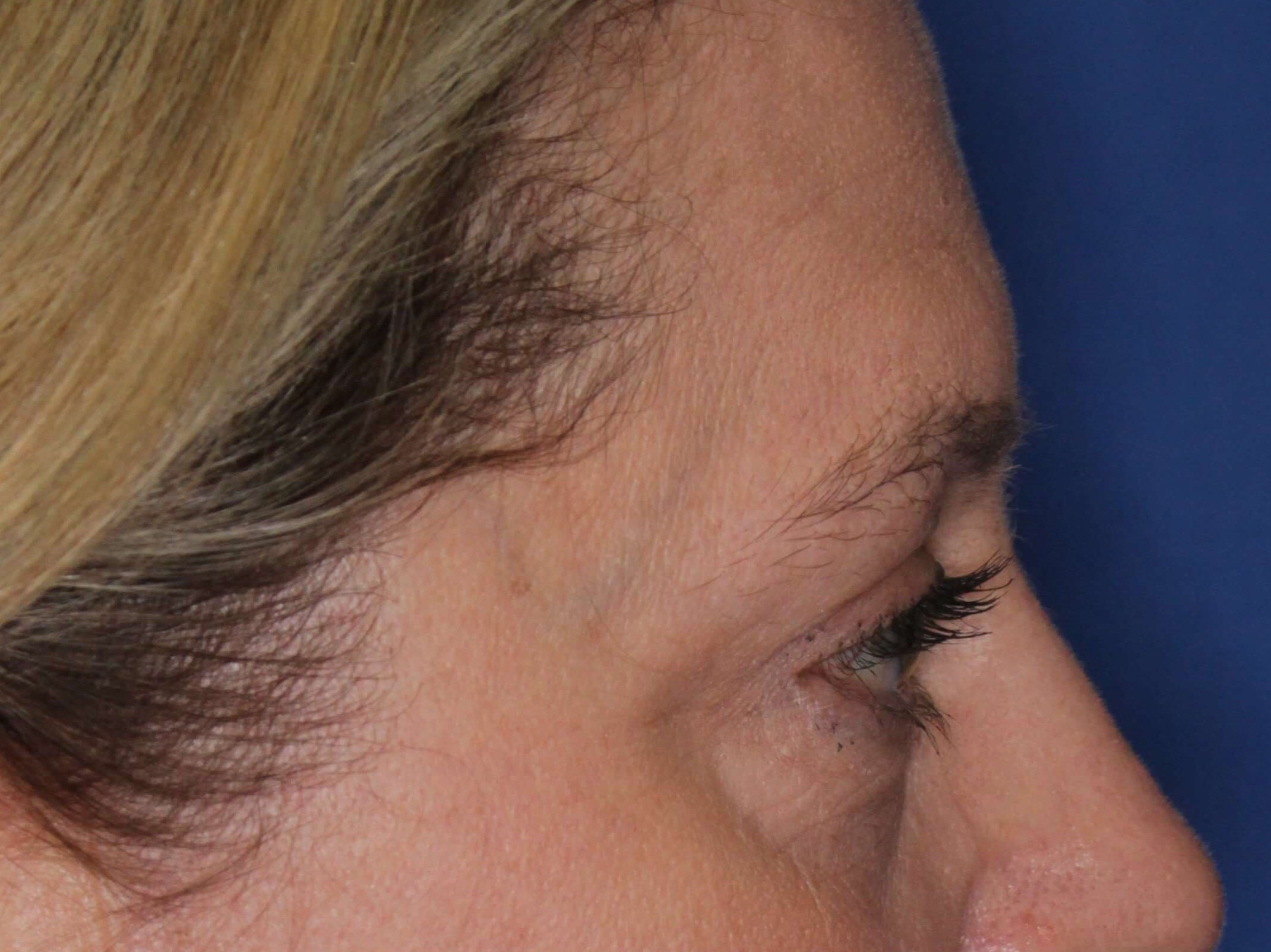 Upper Eyelid Lift After