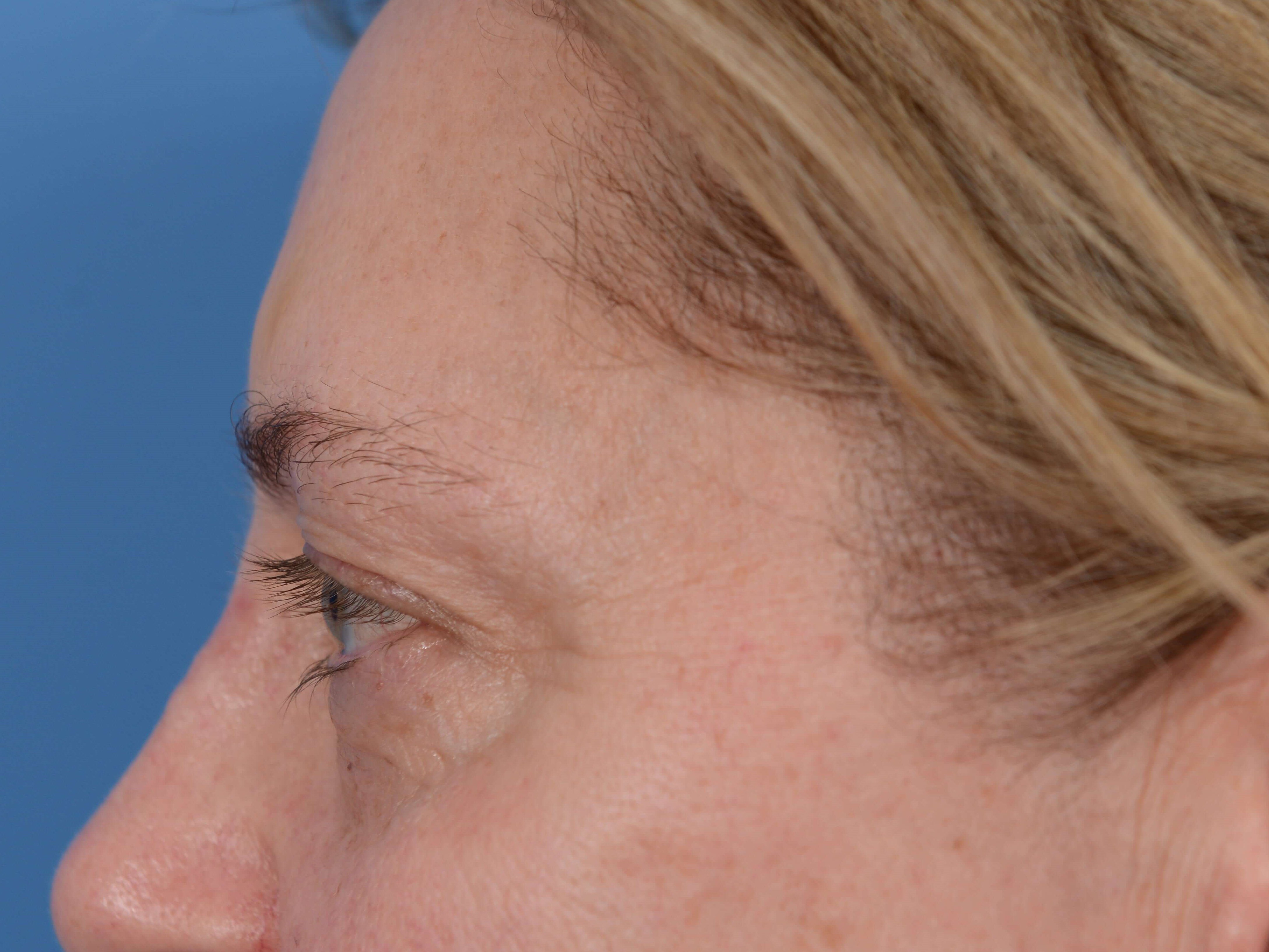 Upper Eyelid Lift Before