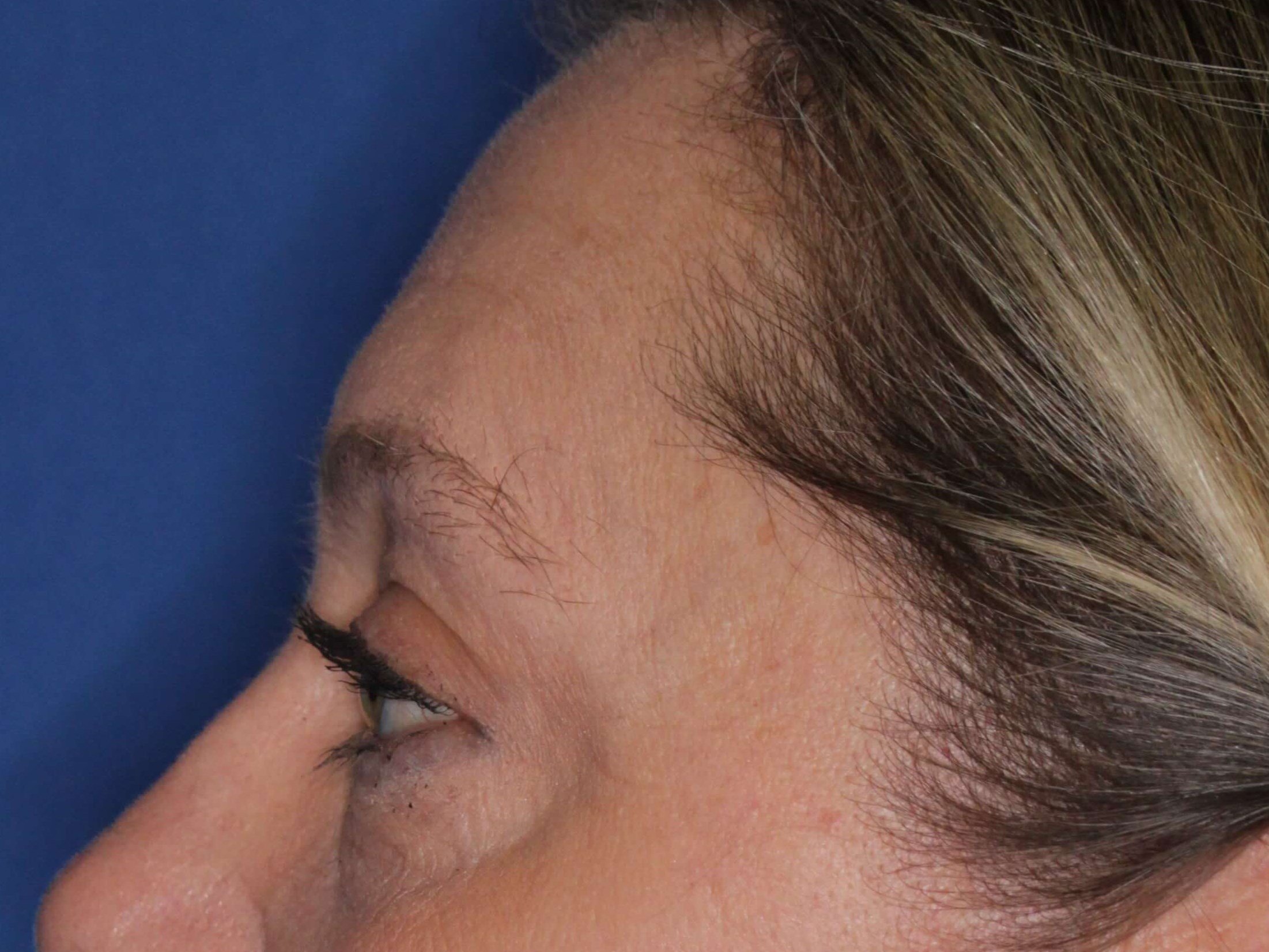 Upper Eyelid Lift After