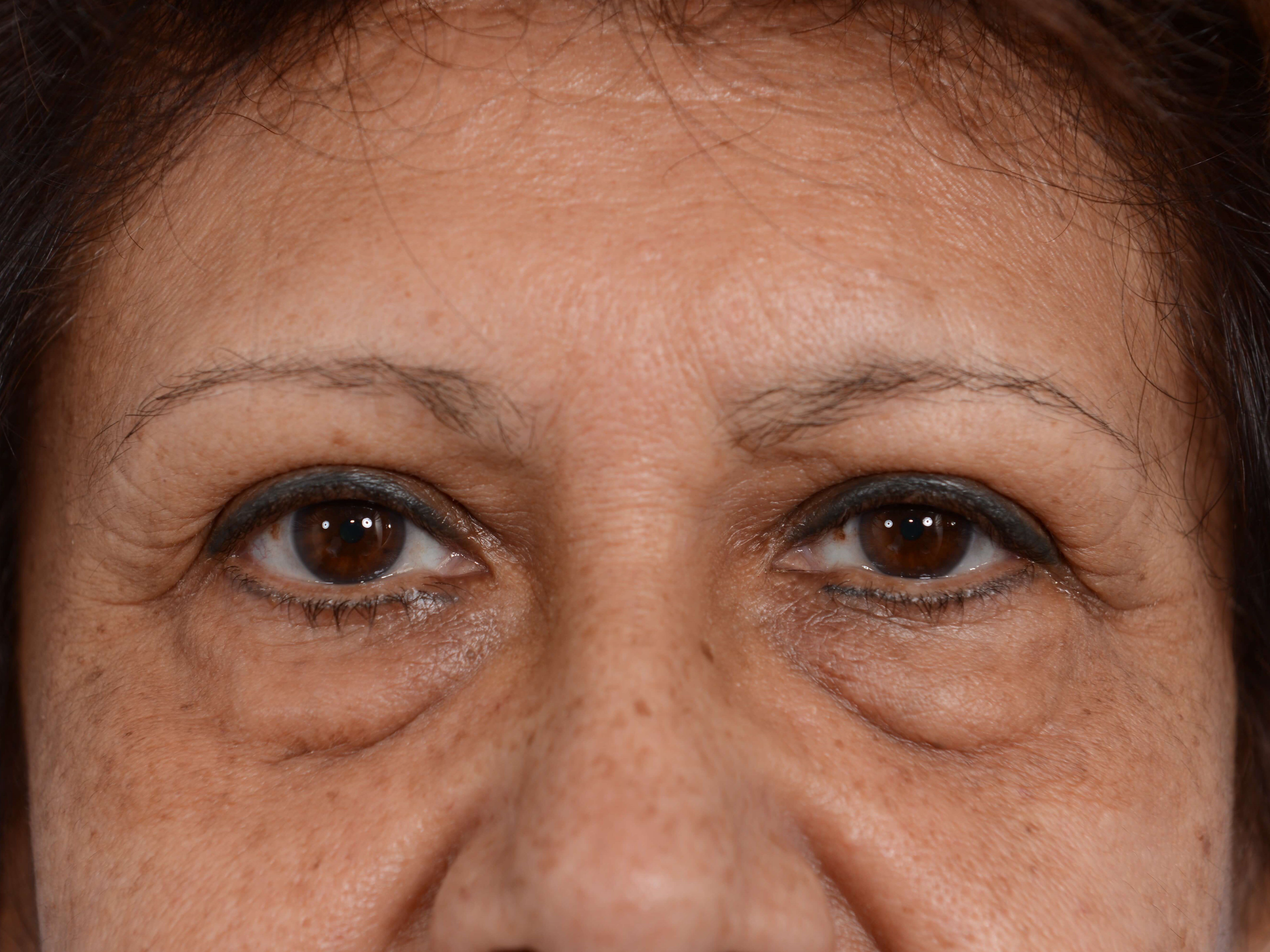 Lower Eyelid Lift Before