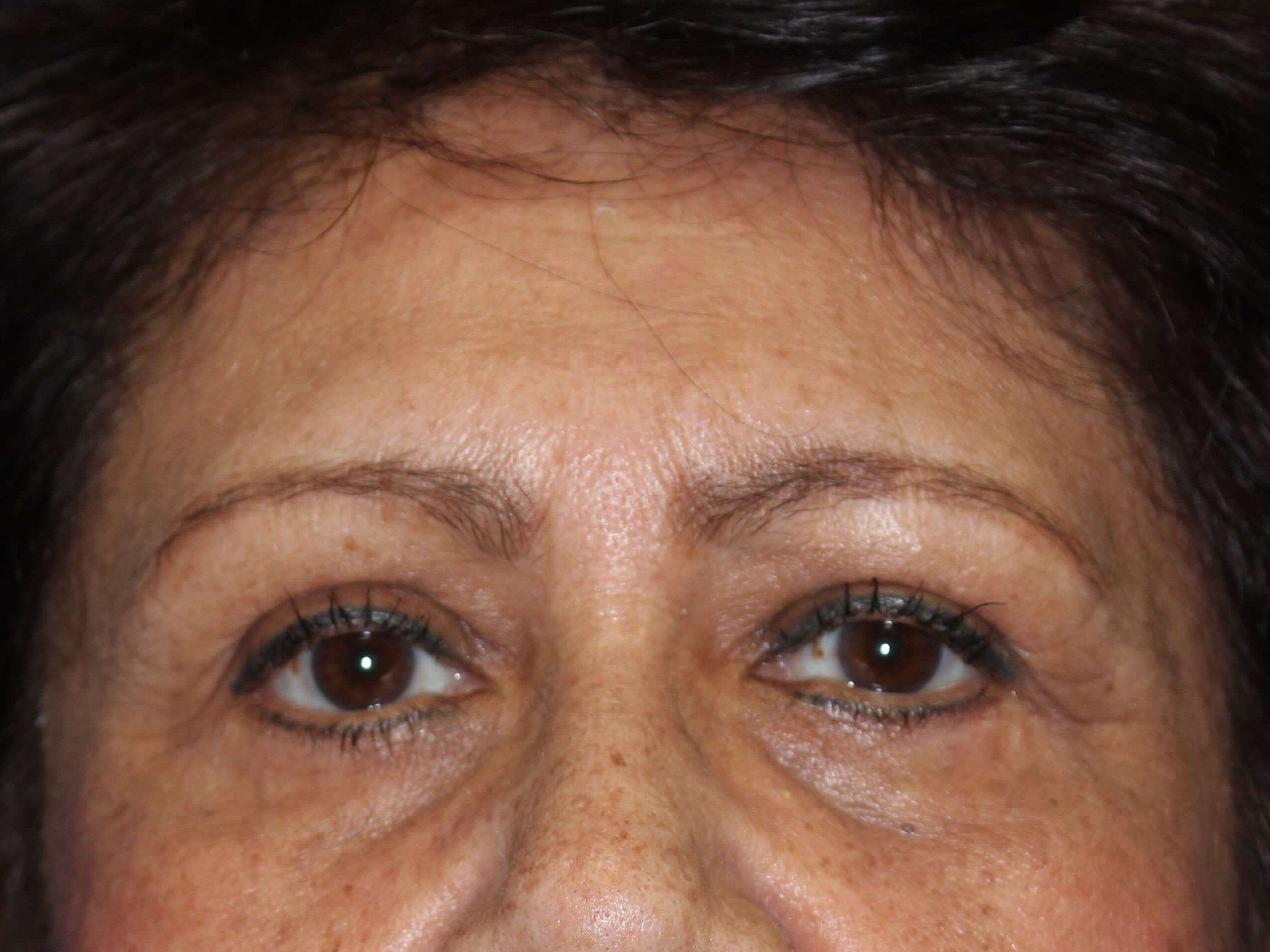 Lower Eyelid Lift After