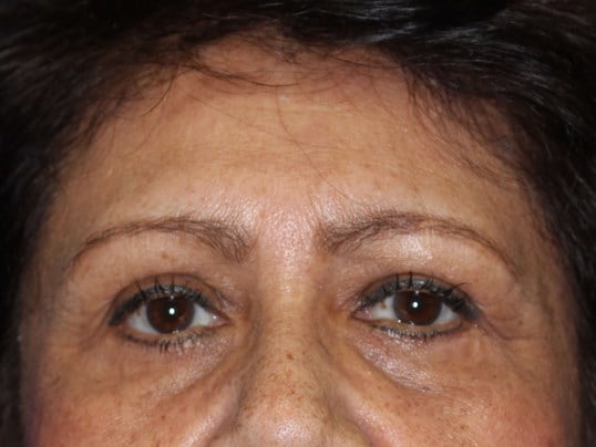 Lower Eyelid Lift After