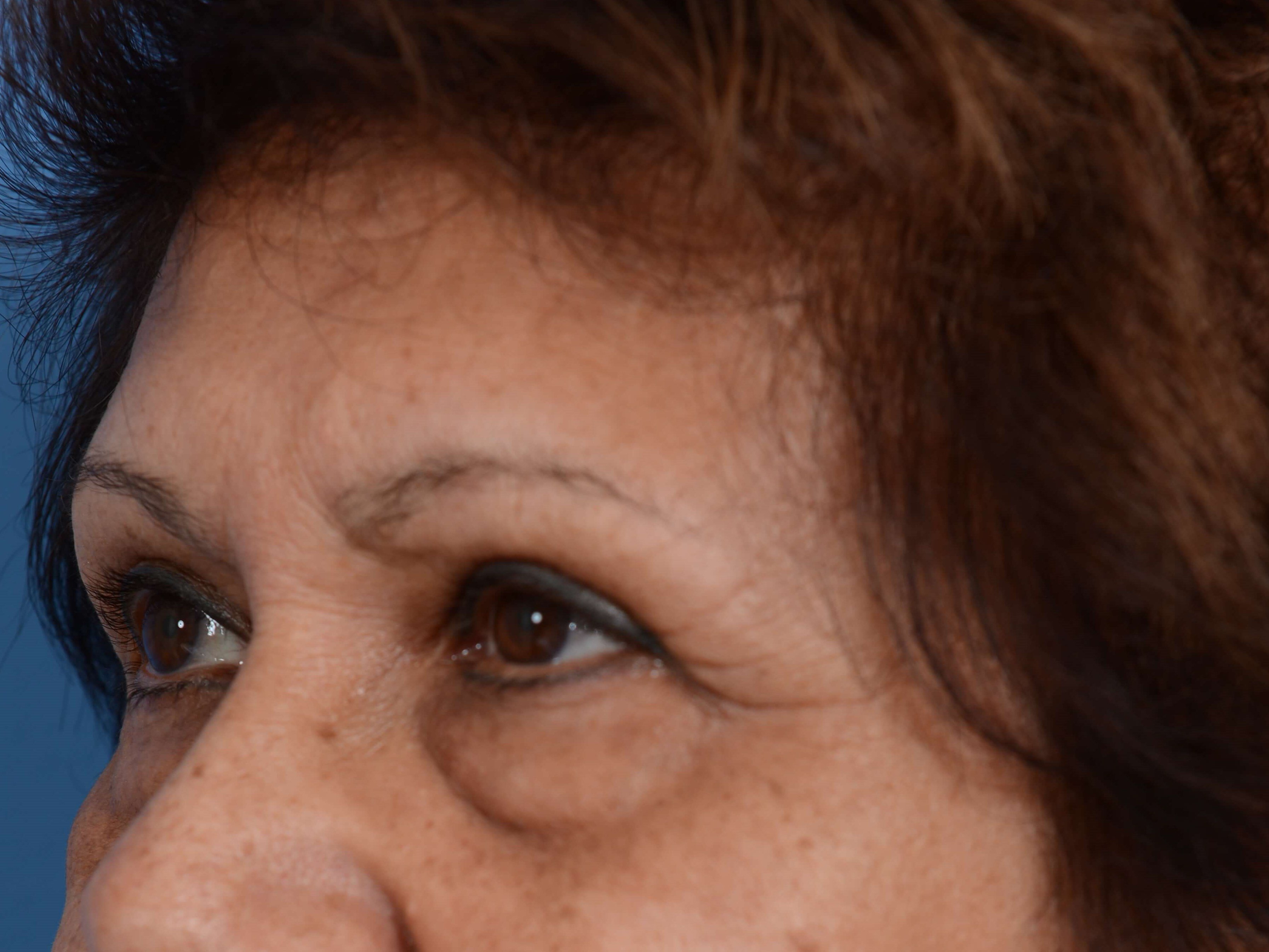 Lower Eyelid Lift Before