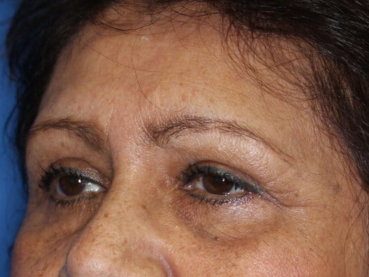 Lower Eyelid Lift After