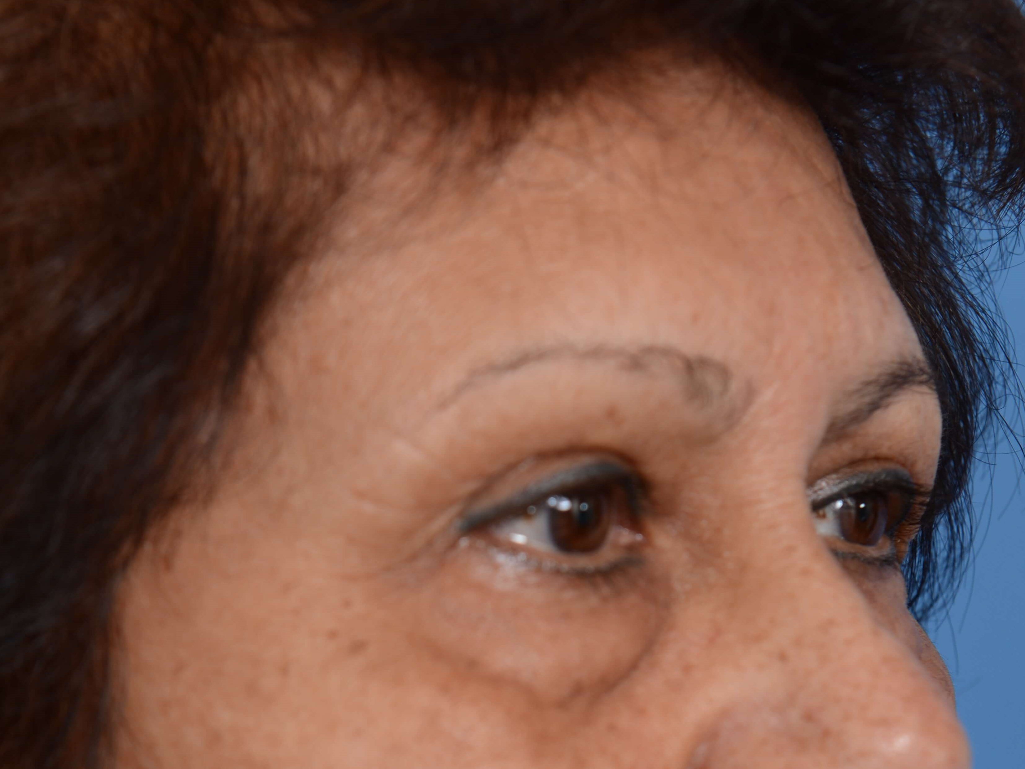 Lower Eyelid Lift Before