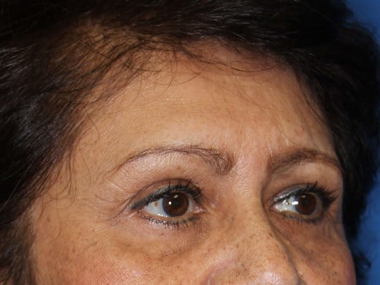 Lower Eyelid Lift After