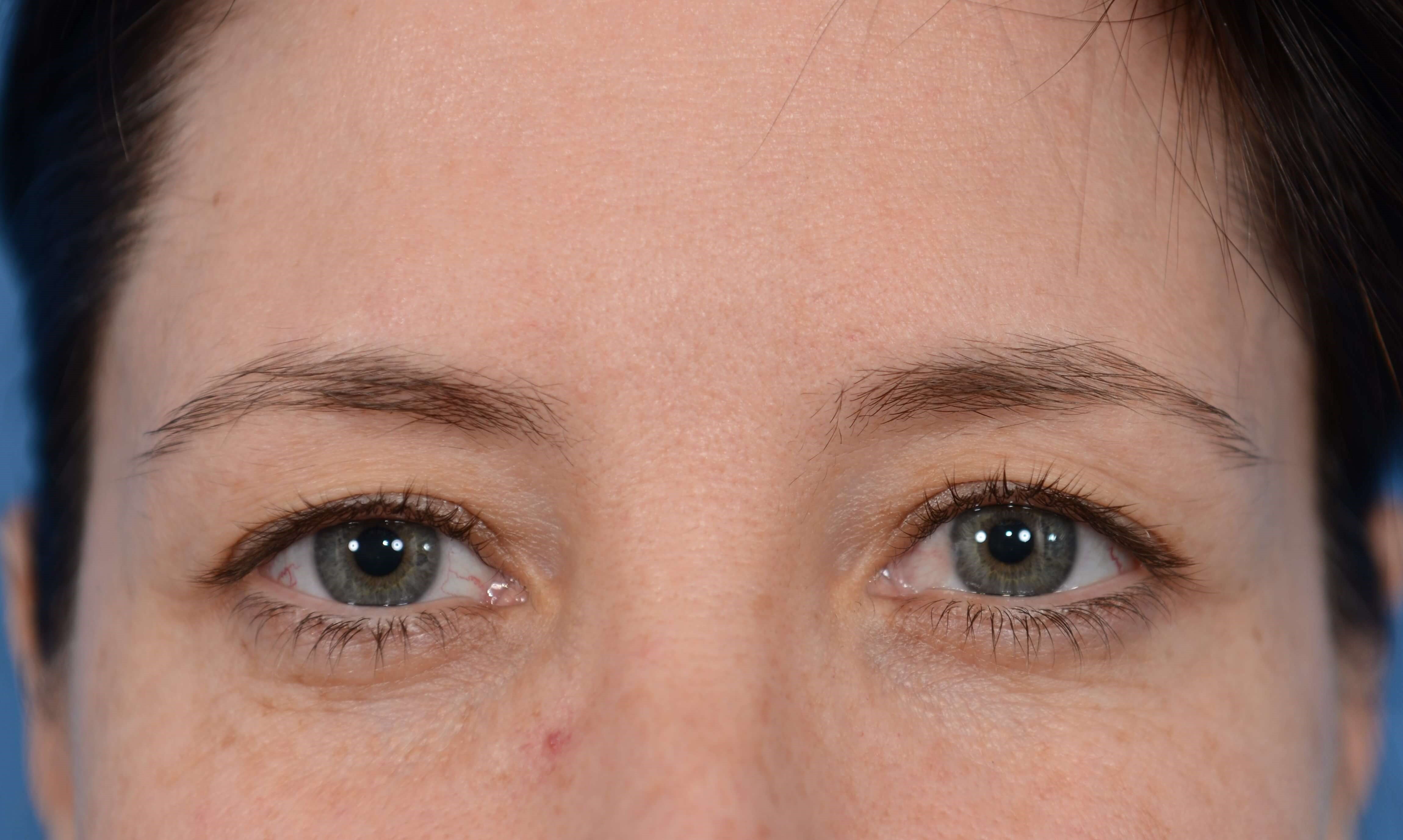 Upper Eylift Before