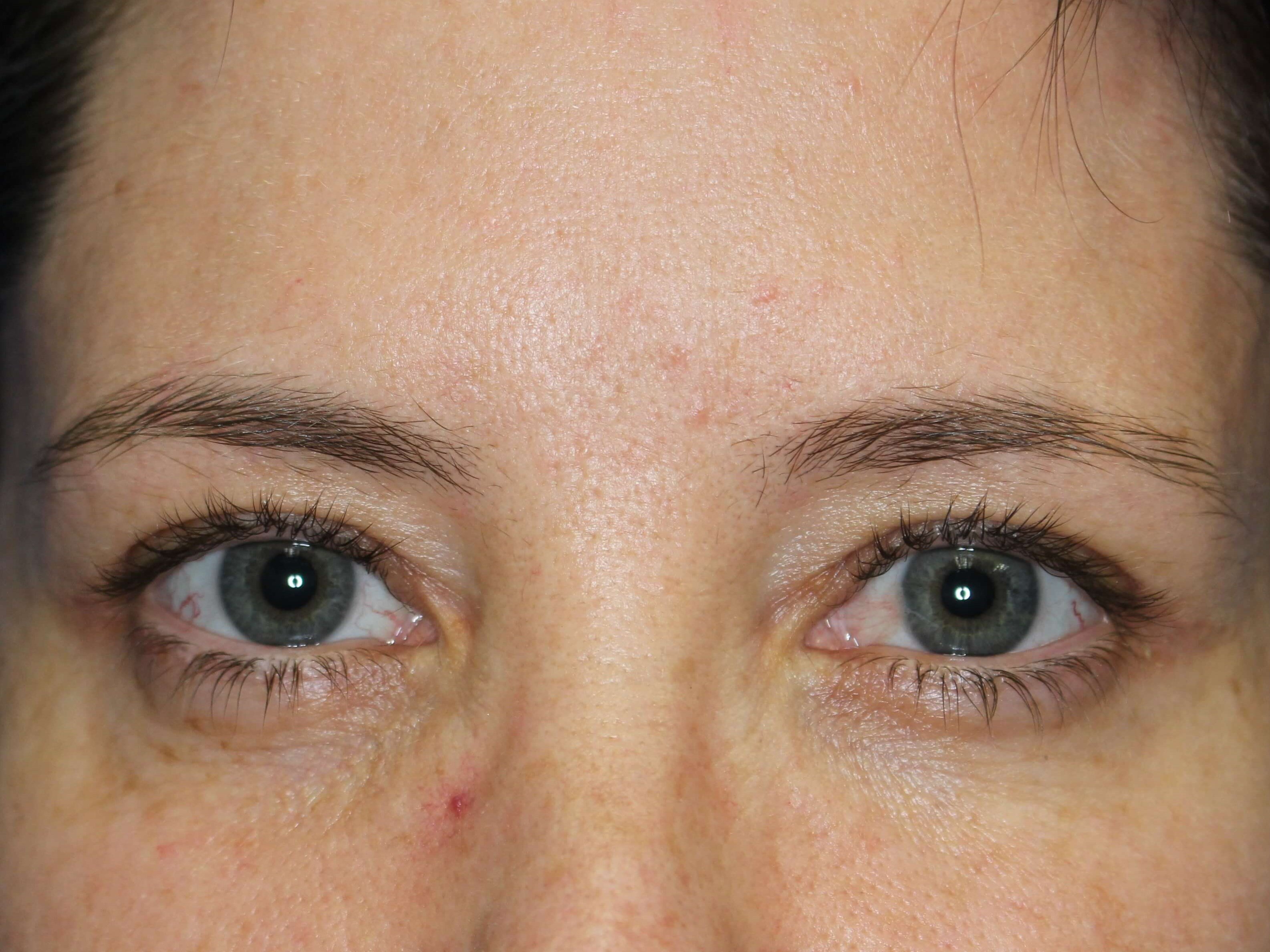 Upper Eylift After