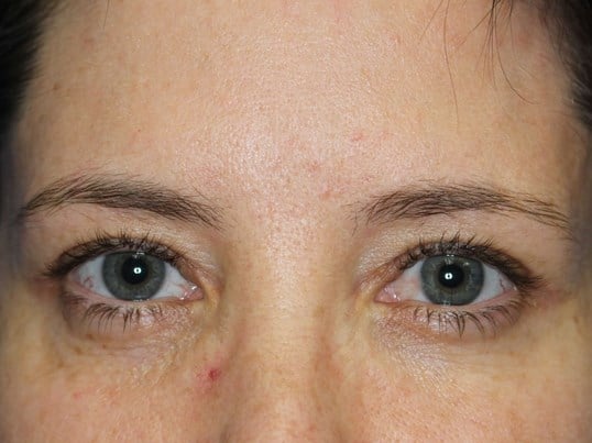 Upper Eylift After