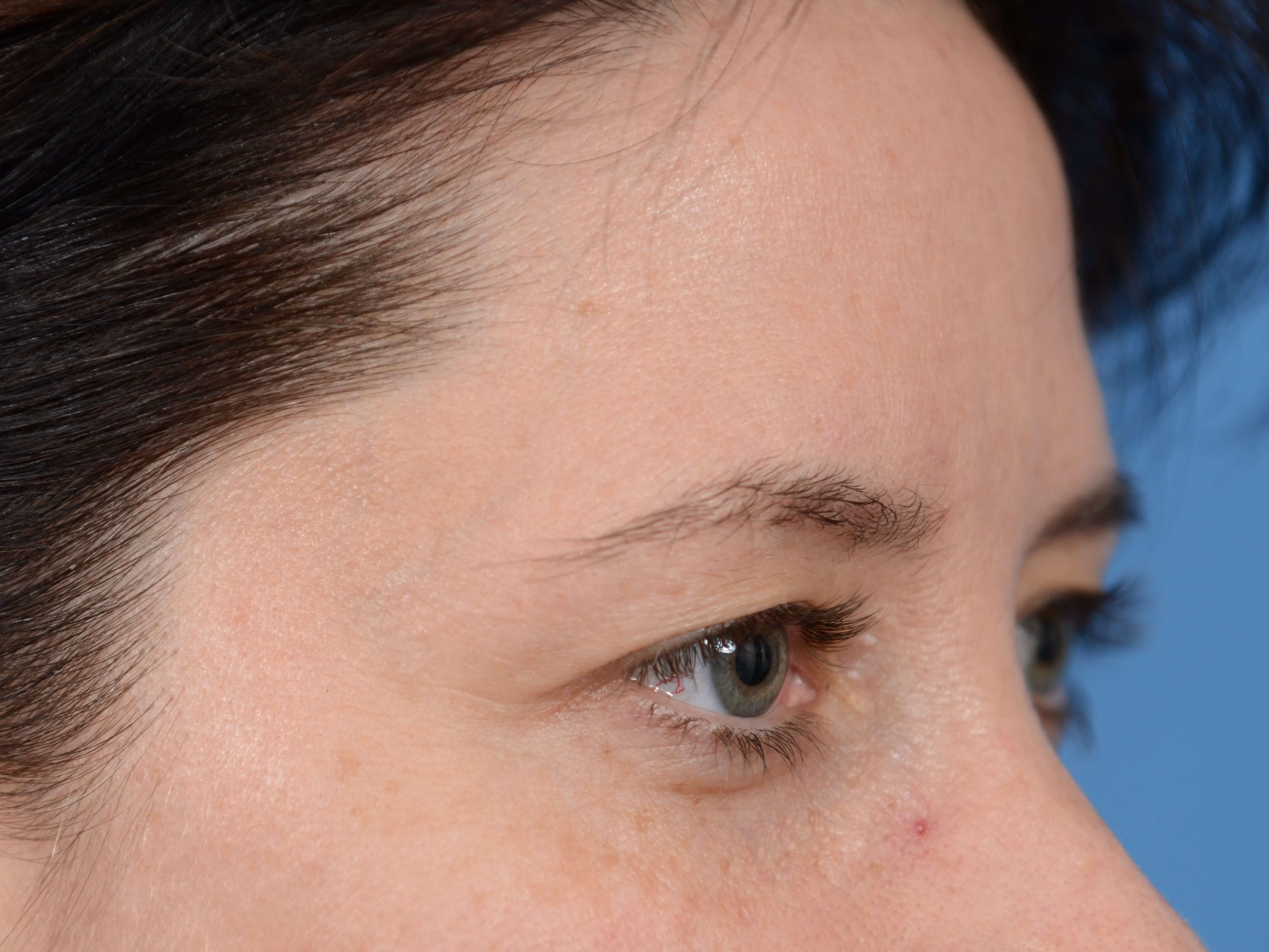 Upper Eyelid Lift Before
