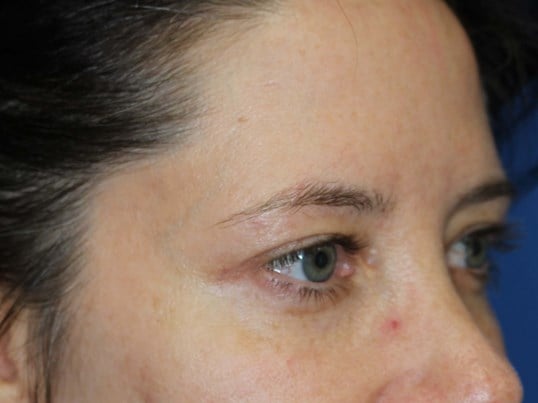 Upper Eyelid Lift After