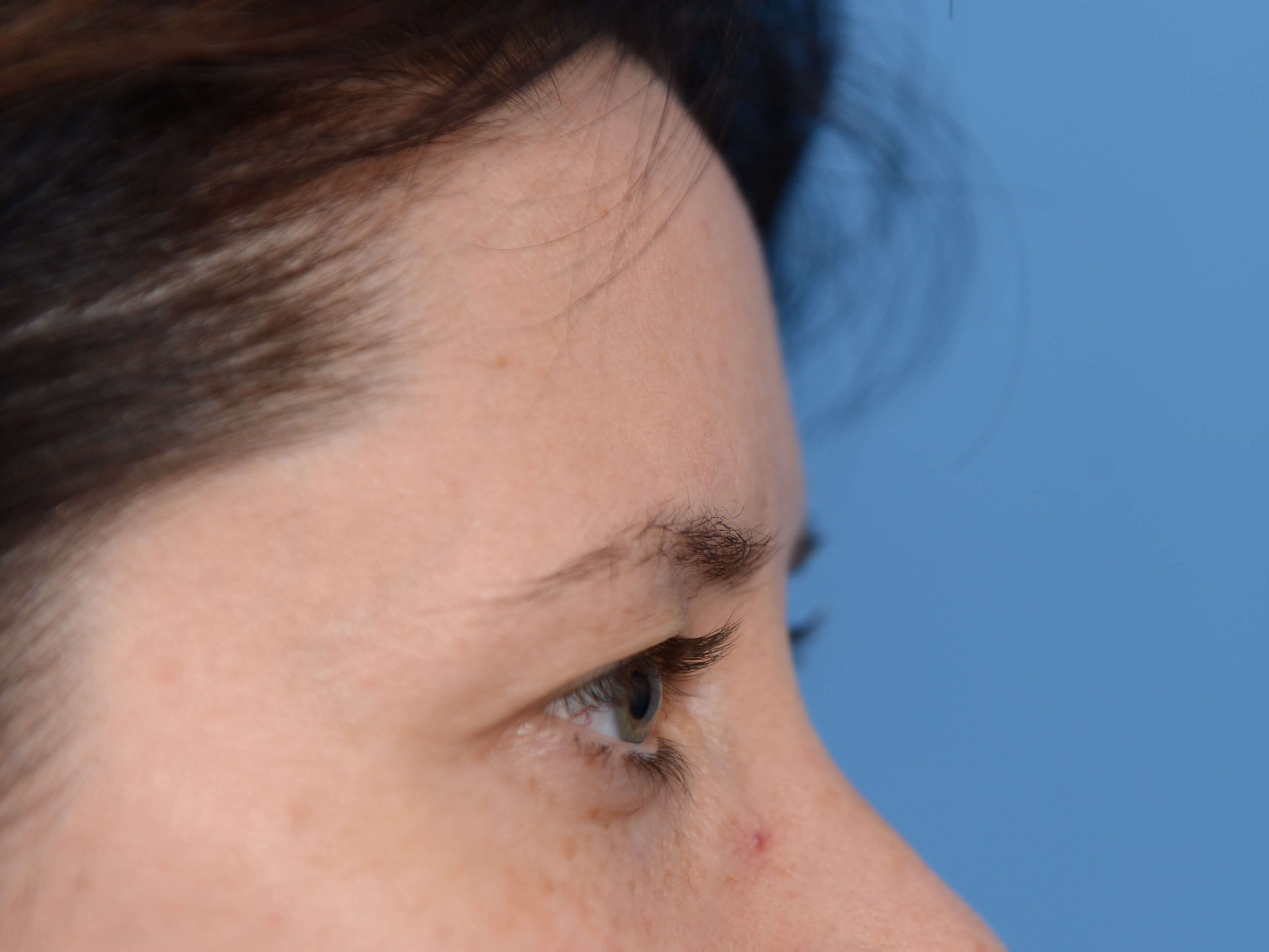 Upper Eyelid Lift Before