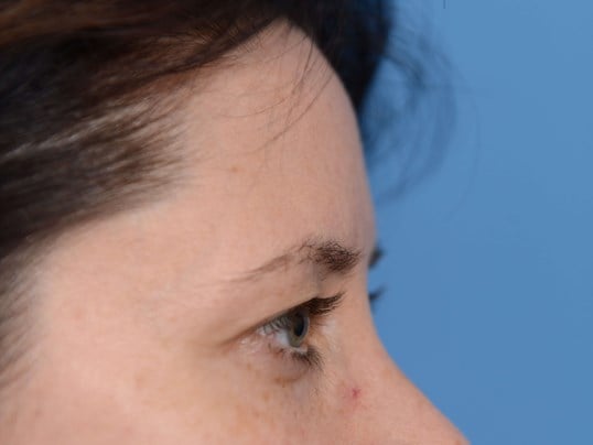 Upper Eyelid Lift Before
