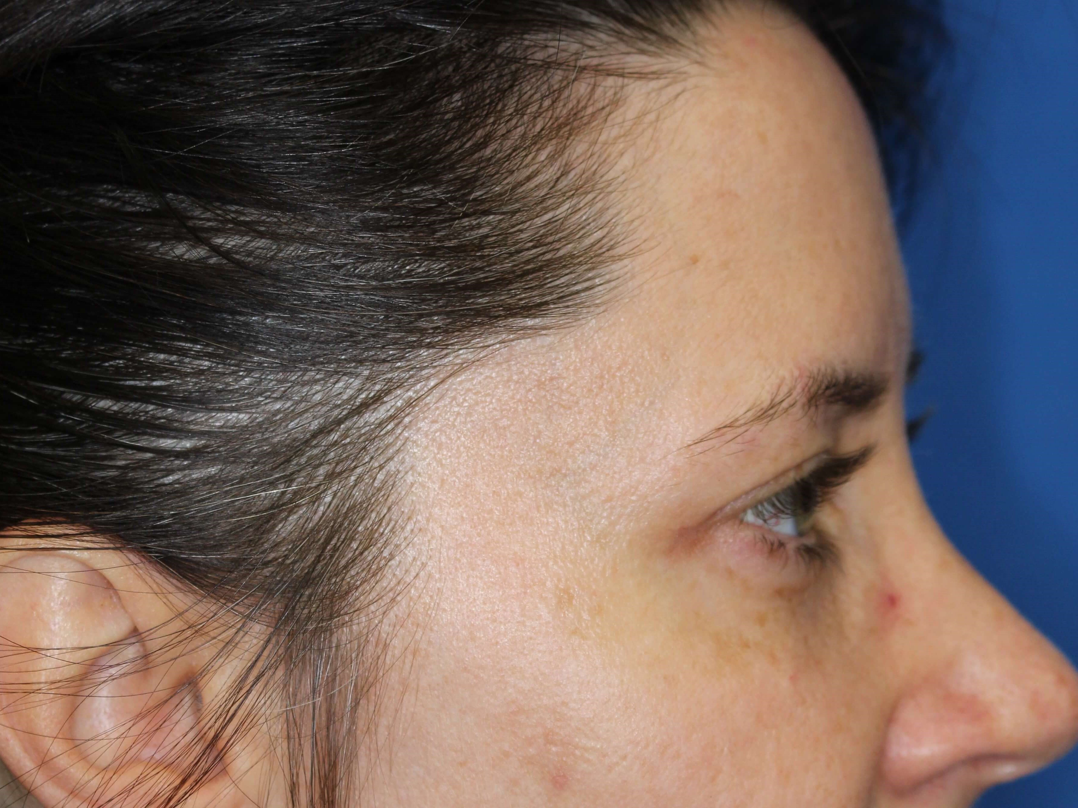 Upper Eyelid Lift After