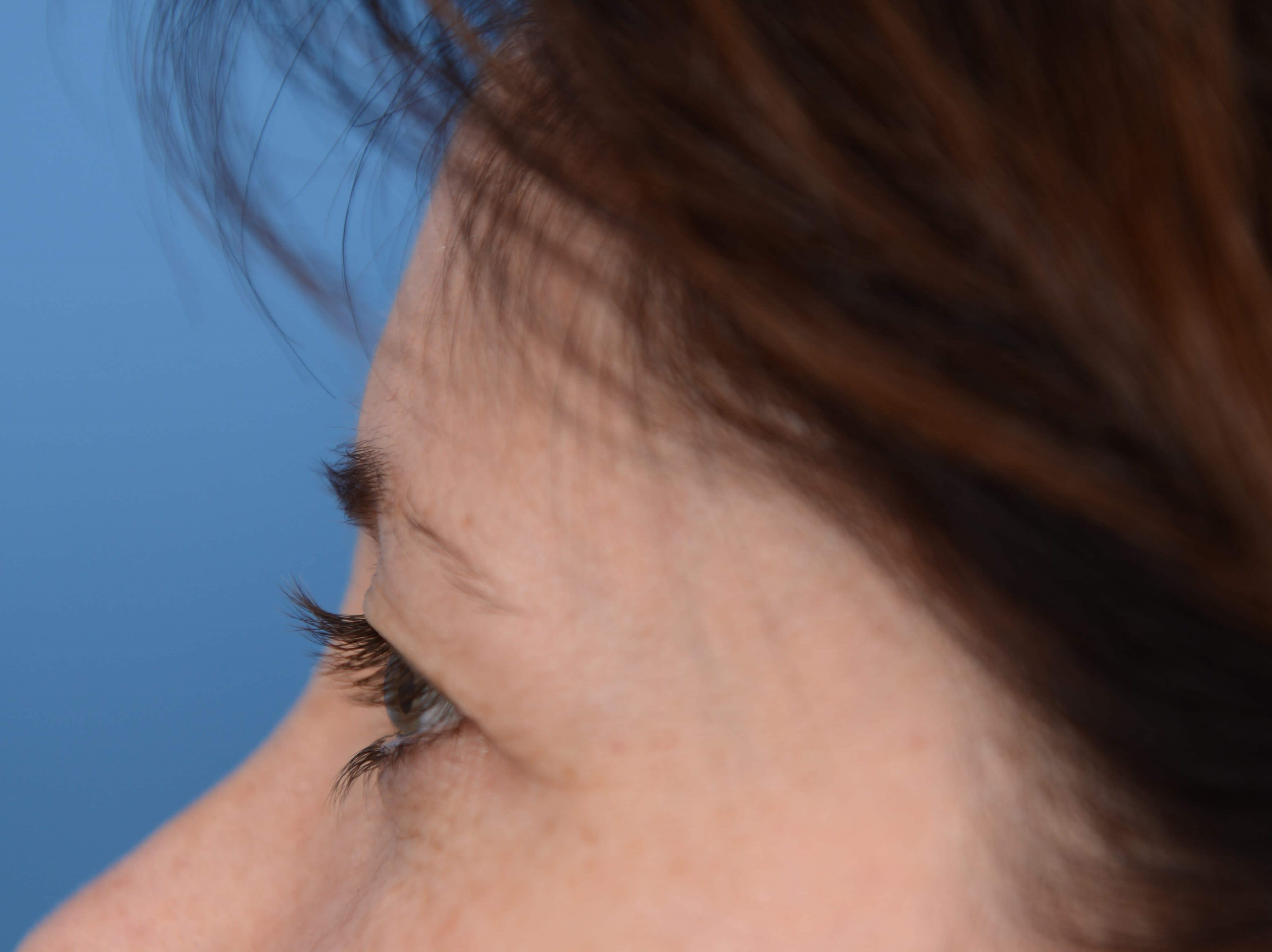 Upper Eyelid Lift Before