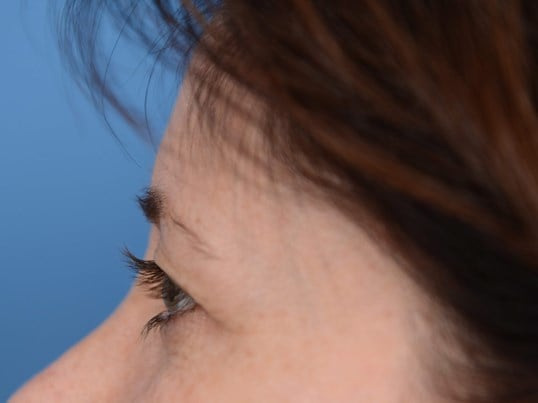 Upper Eyelid Lift Before