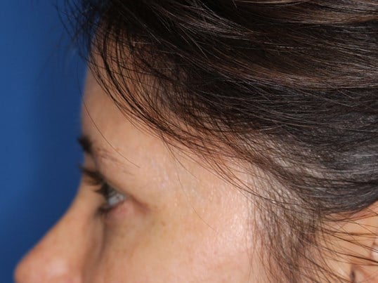 Upper Eyelid Lift After