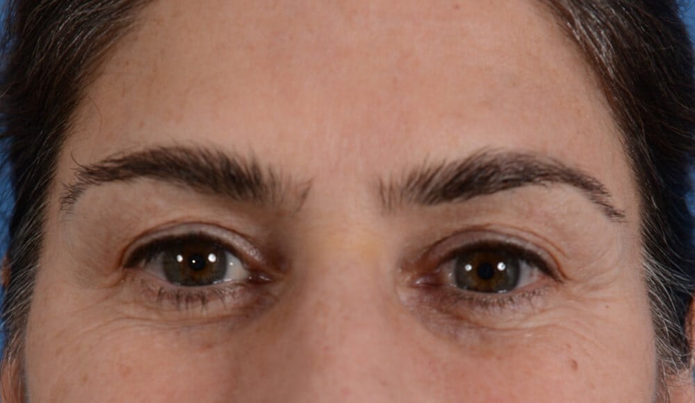 Eyelid Lift Before