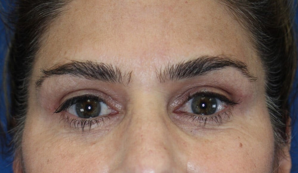 Eyelid Lift After
