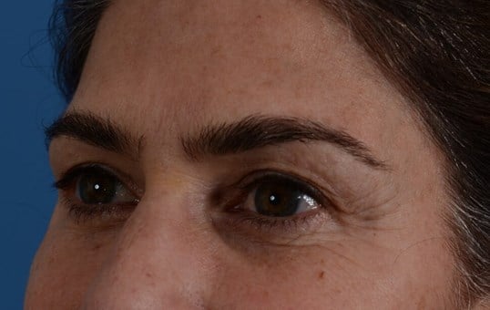 Upper Eyelid Lift Before