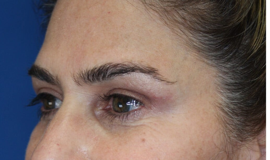 Upper Eyelid Lift After