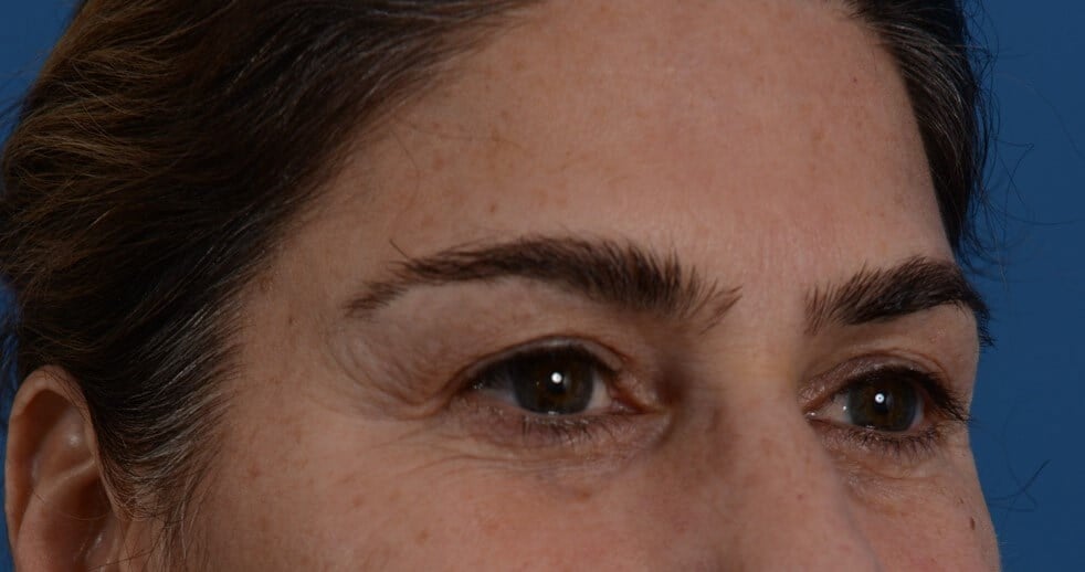 Upper Eyelid Lift Before