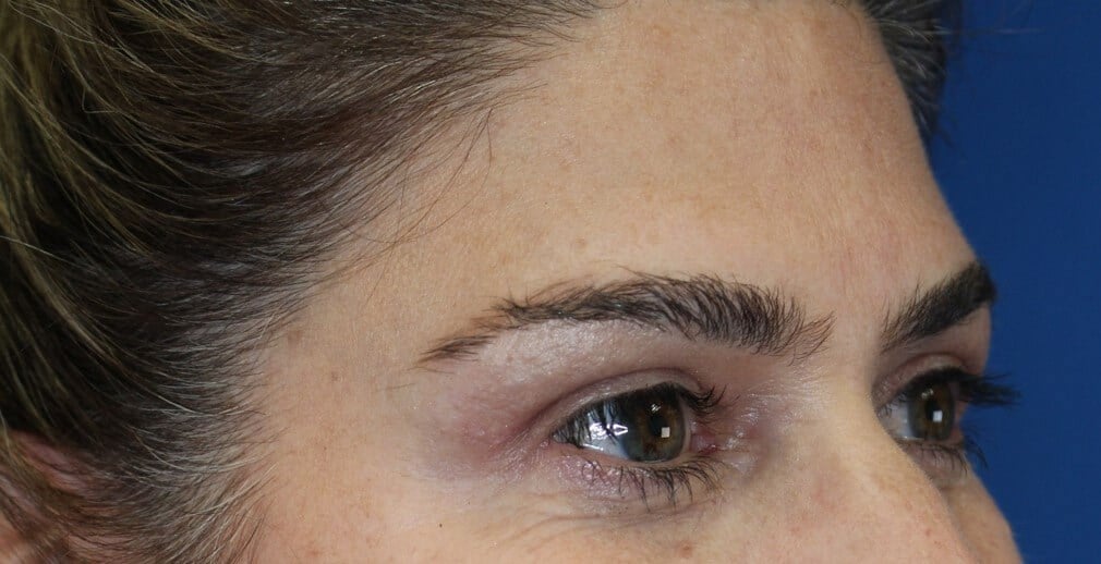 Upper Eyelid Lift After